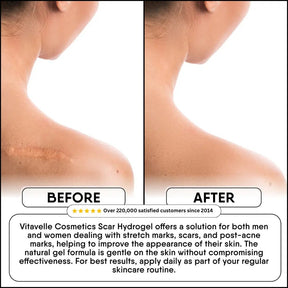 Scar Hydrogel - Vitavelle Cosmetics USA